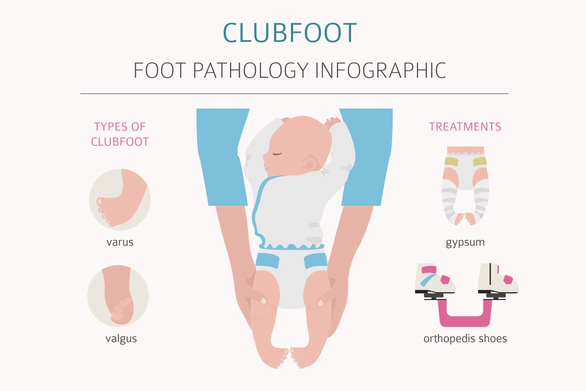 Clubfoot Treatment in Children