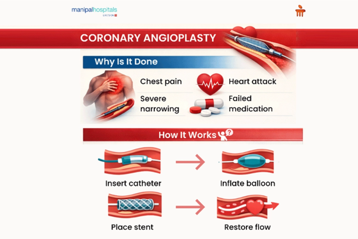 Coronary Angioplasty Stent Procedure