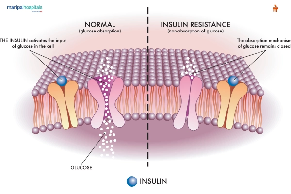 Diabetes as a global epidemic: prevention and cross-border management strategies