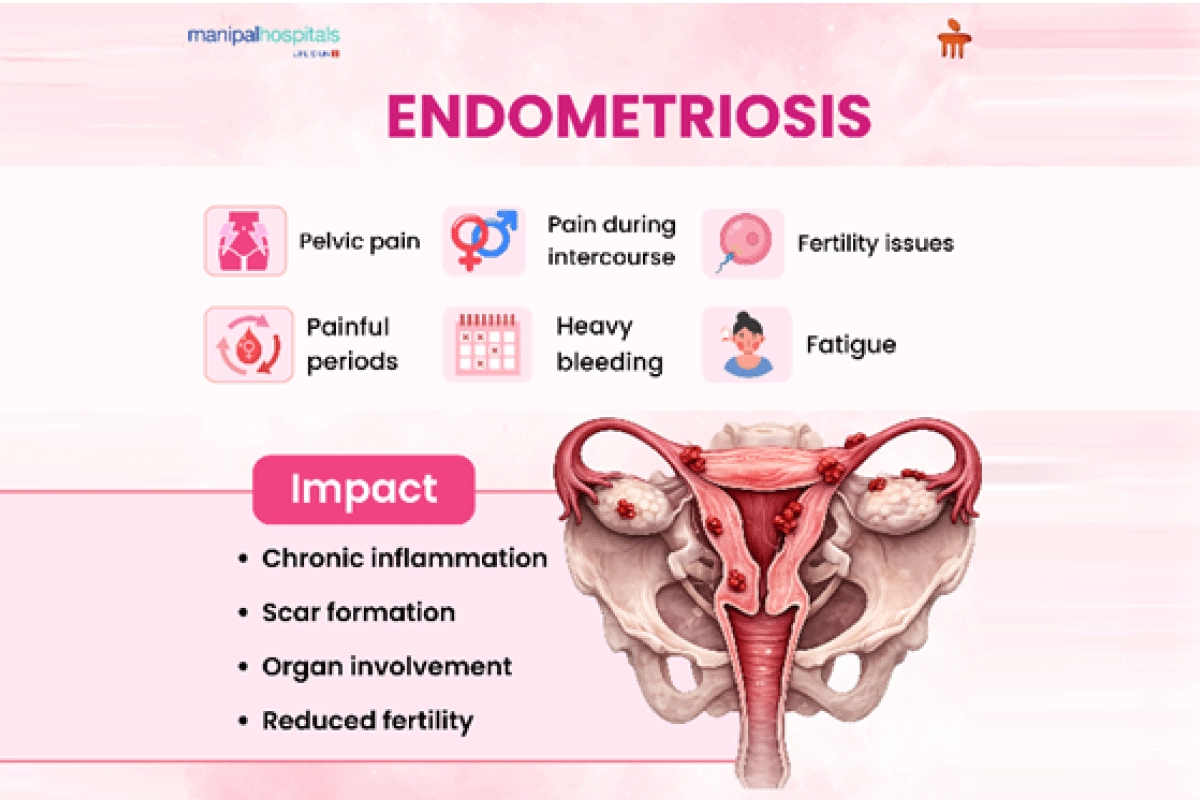 Endometriosis Treatment & Surgery Options