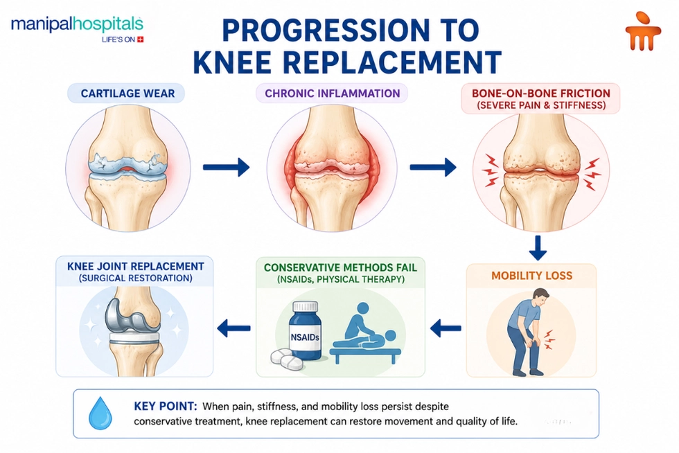 Progression to Knee Replacement Progression to Knee Replacement
